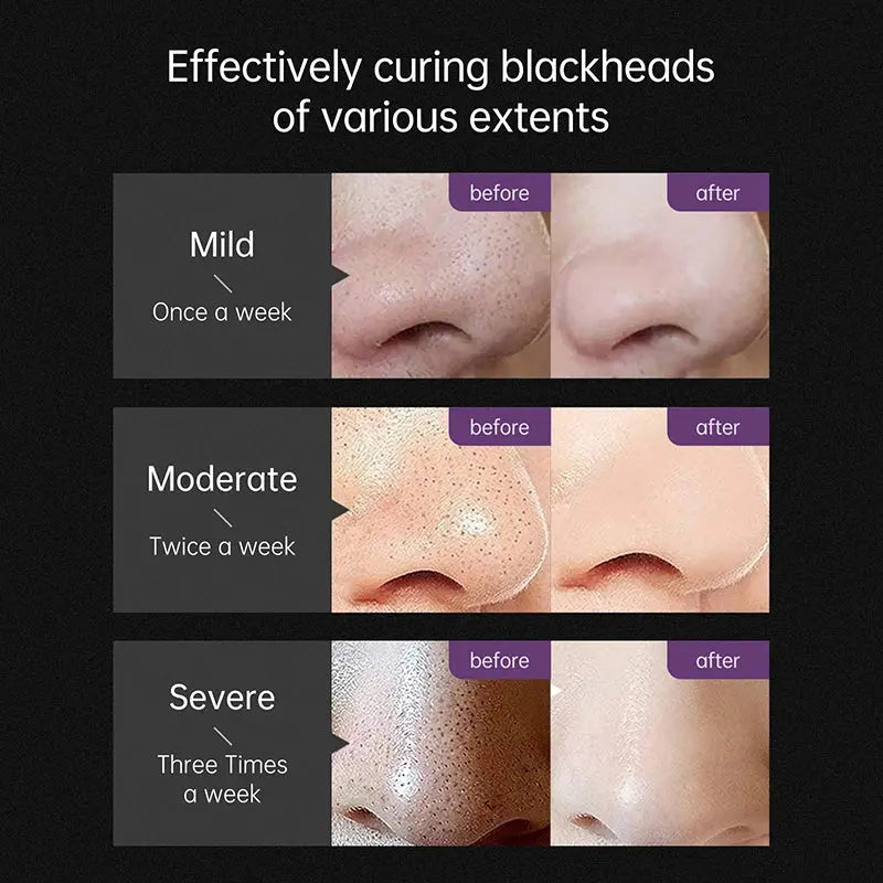 AUQUEST Blackhead Remover Black Dots Facial Masks NoseBamboo Charcoal Point Pimple Anti Acne Spot Face Skin Care Beauty Health - thekoda.online